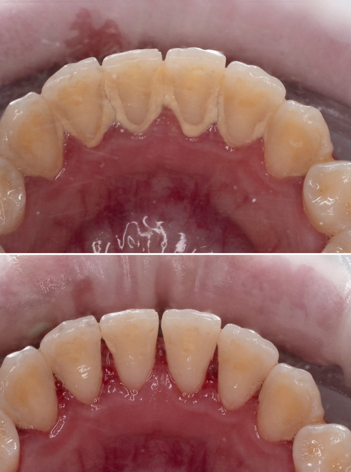 teeth whitening 2